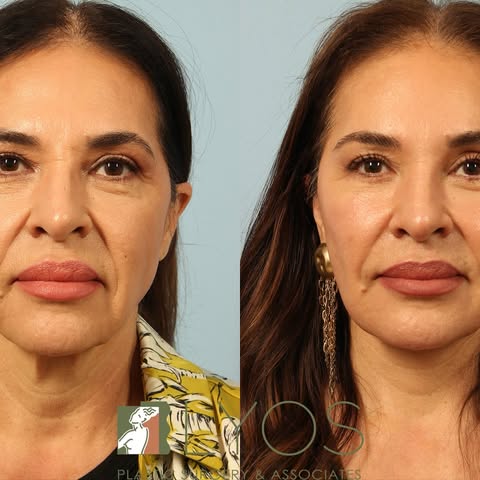 When surgery meets artistry, magic happens! This isn’t just a Face and Necklift this is ART ✨ 

Inte