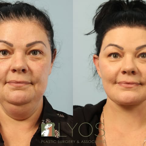 Check out these amazing SMAS Lift results ✨ 

Patient Testimonial: This surgeon sure has a “gifted a