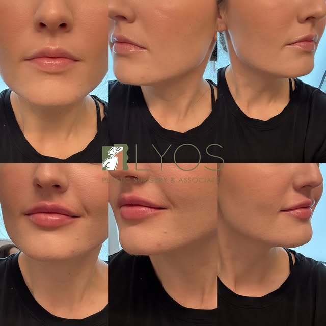 Precision, artistry, and a soft bridal finish 💍✨💉👄 

Lips by Dr. Lyos 

#bridalseries #lipfiller 