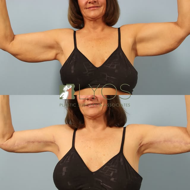 Sculpting confidence from every angle ✨ 

A brachioplasty (arm lift) removes excess skin and reshape