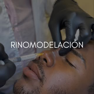 👉La Rinomodelación sin cirugía es un procedimiento inyectable con ácido hialurónico para moldear la