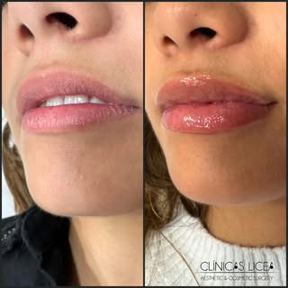 Labios con ácido Hialurónico 👄 

Cambios sutiles y naturales ✨

Los beneficios de este tratamiento 