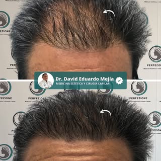 Cada caso es una oportunidad para recuperar densidad y naturalidad.
Este paciente acudió con alopeci