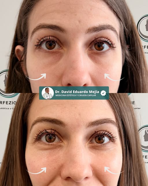 ✨ Una mirada descansada puede cambiar la expresión de todo el rostro.

El relleno de ojeras con Alge