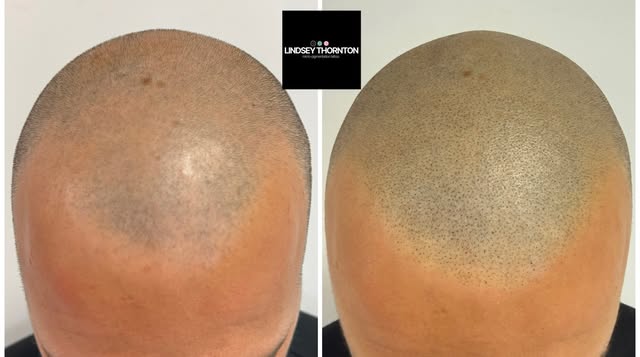 Mega Monday in clinic today, starting with this second session.  Look at the layering and how undete