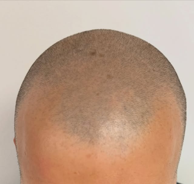 Swipe…👆
My client is thinning throughout so he likes to have his hair shaved short.  However,I have