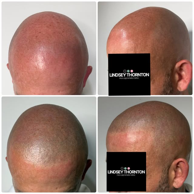 Something a little more sharp for the hairline.  Full head third session SMP.

Super soft fine tatto