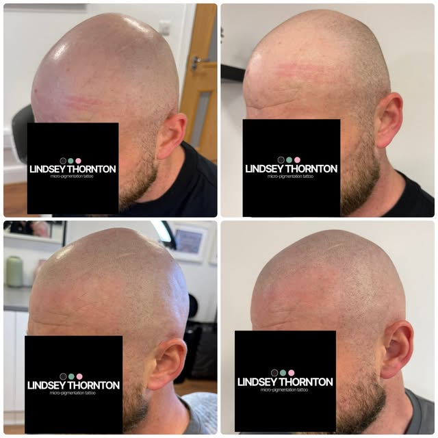 These photos show before SMP and after the 2nd session.  I wanted to show how really light, soft lay