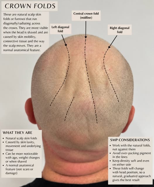 Who do you know that has crown folds? 

I have treated a lot of clients with these.  Some can be at 
