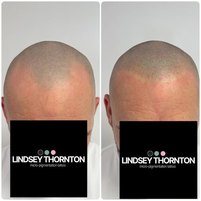 FIRST SESSION SMP. 🖤

For today’s session we have mapped the starting point of the hairline.  My cl
