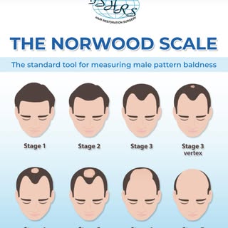For androgenetic #alopecia 95% of the male population falls into the Norwood scale, the other 5% is 