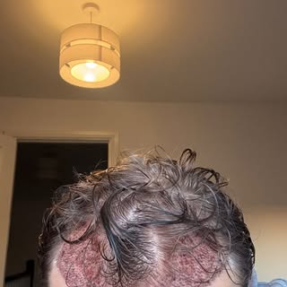 My 25 year old patient came yo me from the #uk for a #hairtransformation procedure. Have to be very 