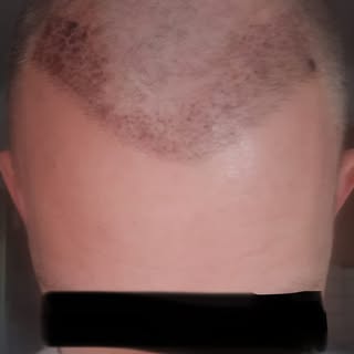 Just received these photos of a 38 year old male patient of mine of the hair transplant of 1500 DHI 