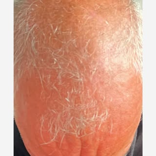 My #UK patient came to me for a 3000 DHI Hair Transplant 6 months ago with already amazing results 
