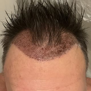 One of my #australia patients, 42 yr old male, sent me these photos after a year of 2500 FU(grafts) 