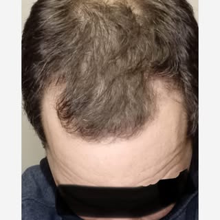 My #belgian male patient only 8 months after the hair transplant, still should pick up density in th