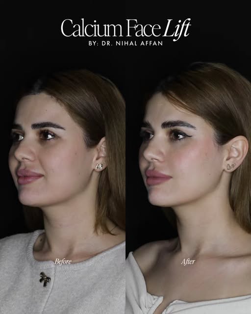 Korean Face Lift (Calcium Lift) by @dr.nihal_affan 💉⬆️ Book now your consultation.

Book Your Appoi