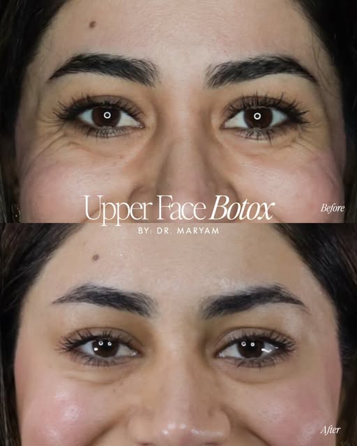 Upper Face Botox treatment by @dr.maryam_askari_ 💉

⚠️ There is no guarantee that the result will b