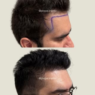 Reducción de entradas con injerto capilar 🙌🏼 Agenda tu valoración gratuita para injerto por WhatsA