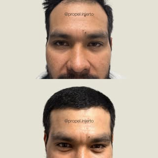 Así se ve un cabello injertado después de 10 meses de haberse realizado 🙌🏼 Recupera tu cabello, re