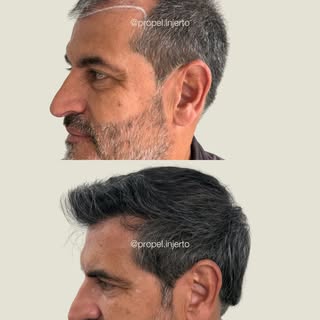 Así se ve un injerto capilar después de 10 meses de haberse realizado con éxito 🙌🏼 Agenda tu valor