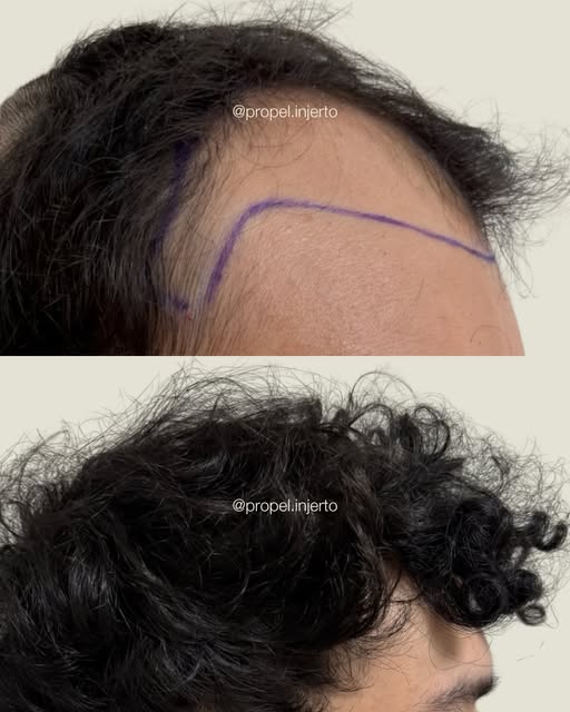 ¿Las entradas de tu cabello te generan inseguridad? Escríbenos por WhatsApp al 3351079332 para conoc
