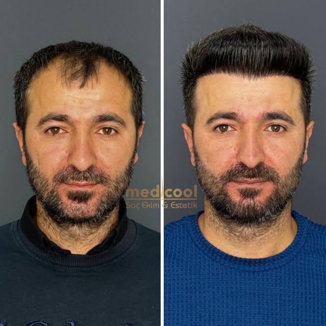 Şehzat Çıtak 4500 GREFT 8.Ay Sonuç!💣

Değişim bir adımla başlar,
Saç ekimiyle daha genç,daha güçlü 