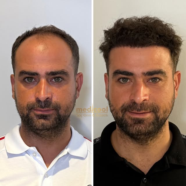 Mahsun Kılıç 4800 GREFT 10.Ay Sonuç!💣

Değişim bir adımla başlar,
Saç ekimiyle daha genç,daha güçlü