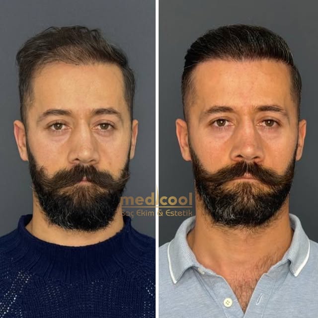 Harun Çiftçi 4500 GREFT 8.Ay Sonuç!💣

Değişim bir adımla başlar,
Saç ekimiyle daha genç,daha güçlü 