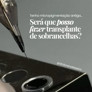 Tenho micropigmentação antiga… posso fazer o transplante?

Depende.
Mas em muitos casos, sim — com a