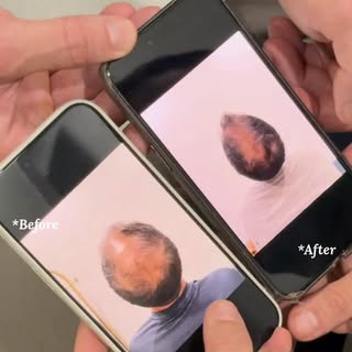 Strong roots grow the best results! 🌱💪⁠

This 3-month transformation came before the transplant — 