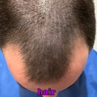 24 hour Hair Transplant progress

#drhairchicago #hair #hairtransplant