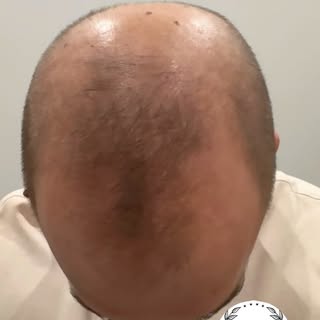 Hair progress six months after FUE transplant.

Dr Hair Chicago (833) 537-4247

#drhairofchicago #ha