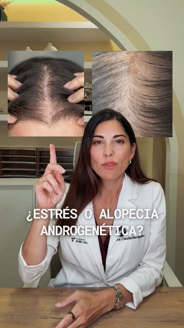 No todo lo que le pasa a tu pelo es estrés.

La alopecia androgenética femenina es una enfermedad de