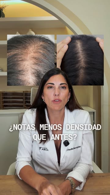 Un día miras una fotografía antigua y piensas: «¿Yo antes tenía más pelo?» 🤔

Ese cambio puede habe