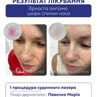 Зірчаста ангіома — судинне утворення, яке можна скоригувати за допомогою судинного лазера ✨

На фото
