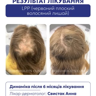LPP — це хронічне запальне захворювання, яке уражає волосяні фолікули та може спричиняти рубцеве вип
