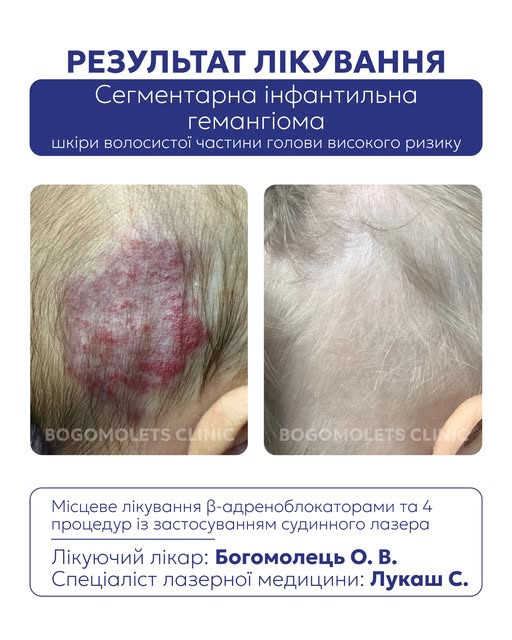 Сегментарна інфантильна гемангіома високого ризику потребує своєчасної діагностики та індивідуальної