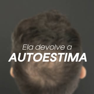 Resultados que vão além da estética.

O antes e depois de um transplante capilar mostra uma transfor