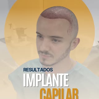 🚨 ASÍ TERMINÓ EL IMPLANTE CAPILAR DE JUAN PABLO… ¡MIRA EL CAMBIO! 🚨
Hace unas horas, Juan Pablo te