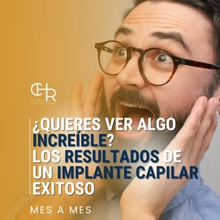 ✨ Resultados que hablan por sí solos ✨
Este es el poder de un implante capilar. Recuperar tu cabello