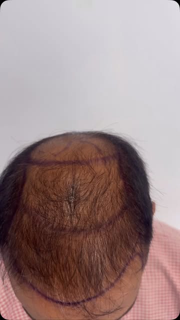 Hair Transplant #cosmeticsurgery #botox #plasticsurgery #skincare #skin