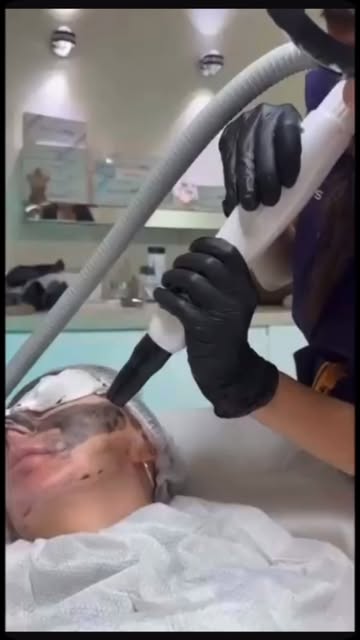 Laser Carbon Therapy #botox #skincare #fillers #fillers #cosmeticsurgery