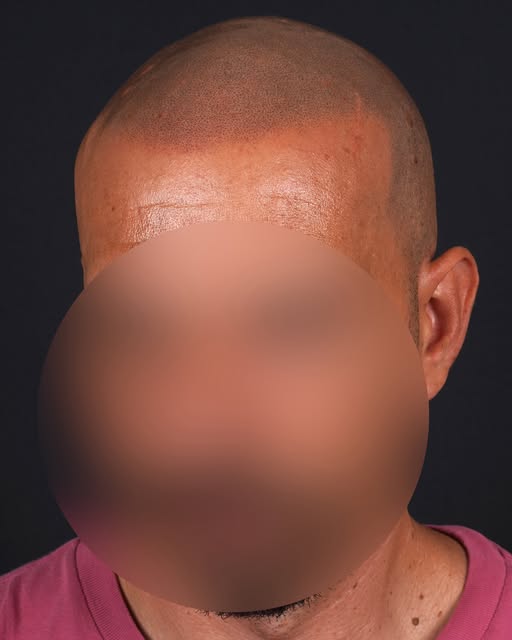 Antes y después.
Micropigmentación Capilar en dos Sesiones, trabajada para recuperar estructura, equ