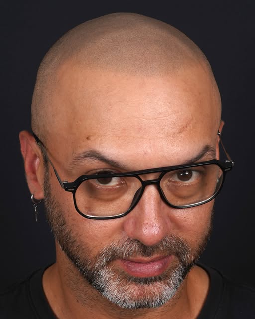 UN AÑO DESPUÉS.

Para mí, la Micropigmentación Capilar tiene un objetivo muy claro.

Conseguir esa s