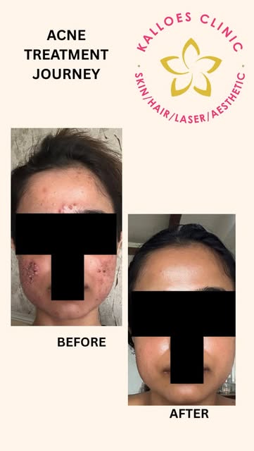 Acne Treatment Journey ✨

A visible improvement achieved with a personalised dermatological treatmen