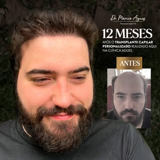Veja o antes e depois surpreendente de quem confiou em nosso protocolo de transplante capilar. Resul