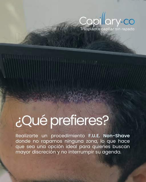 ¿Prefieres raparte o no? La elección también depende de ti.

El FUE Non-Shave o FUE sin rapado es un