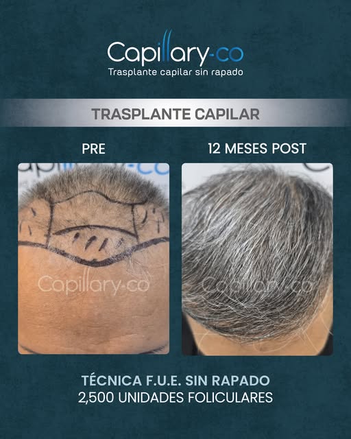 ¡Recupera tu cabello sin raparte!

🔹Megasesión de 2,500 unidades foliculares 
🔹Técnica: F.U.E. sin