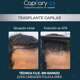 ¡Recupera tu cabello sin raparte!

🔹2,000 unidades foliculares 
🔹Técnica: F.U.E. sin rapado 
🔹 Ev